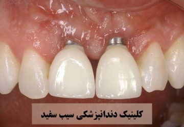 علت لق شدن ایمپلنت دندان